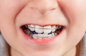 Appareillage pour jeune enfant